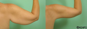 Upper arm – before and after