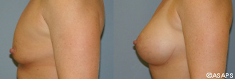 Breast surgery – before and after