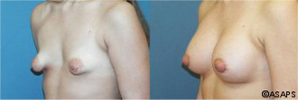 Breast surgery – before and after
