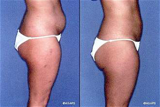 Liposuction – before and after