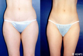 Liposuction – before and after