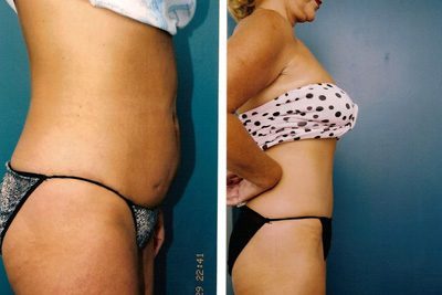 Tummy tuck – before and after