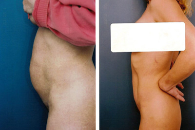 Tummy tuck – before and after