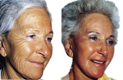 Facelift – before and after