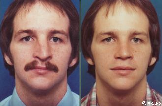 Rhinoplasty – before and after