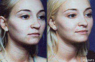 Rhinoplasty – before and after