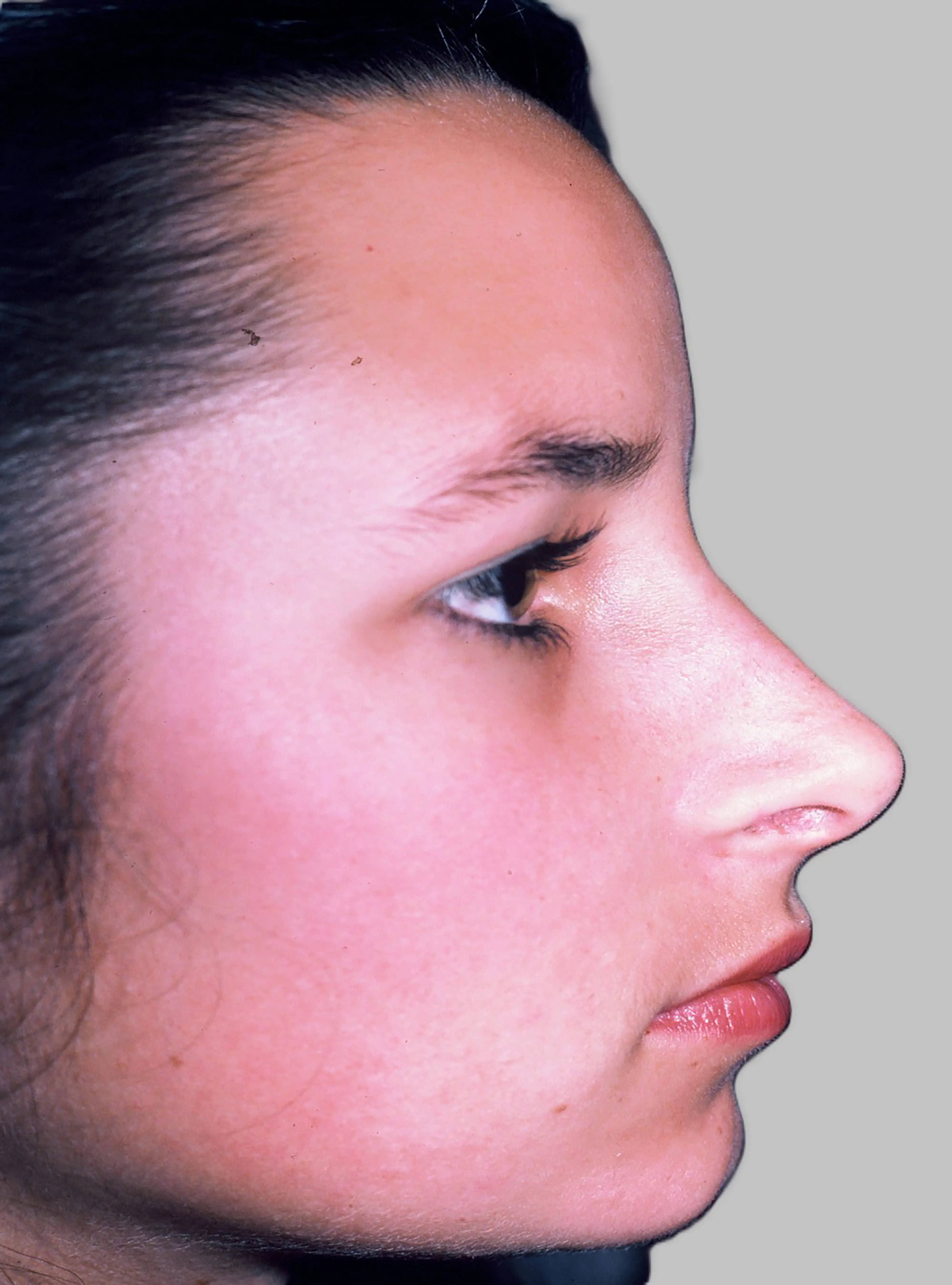 Rhinoplasty After