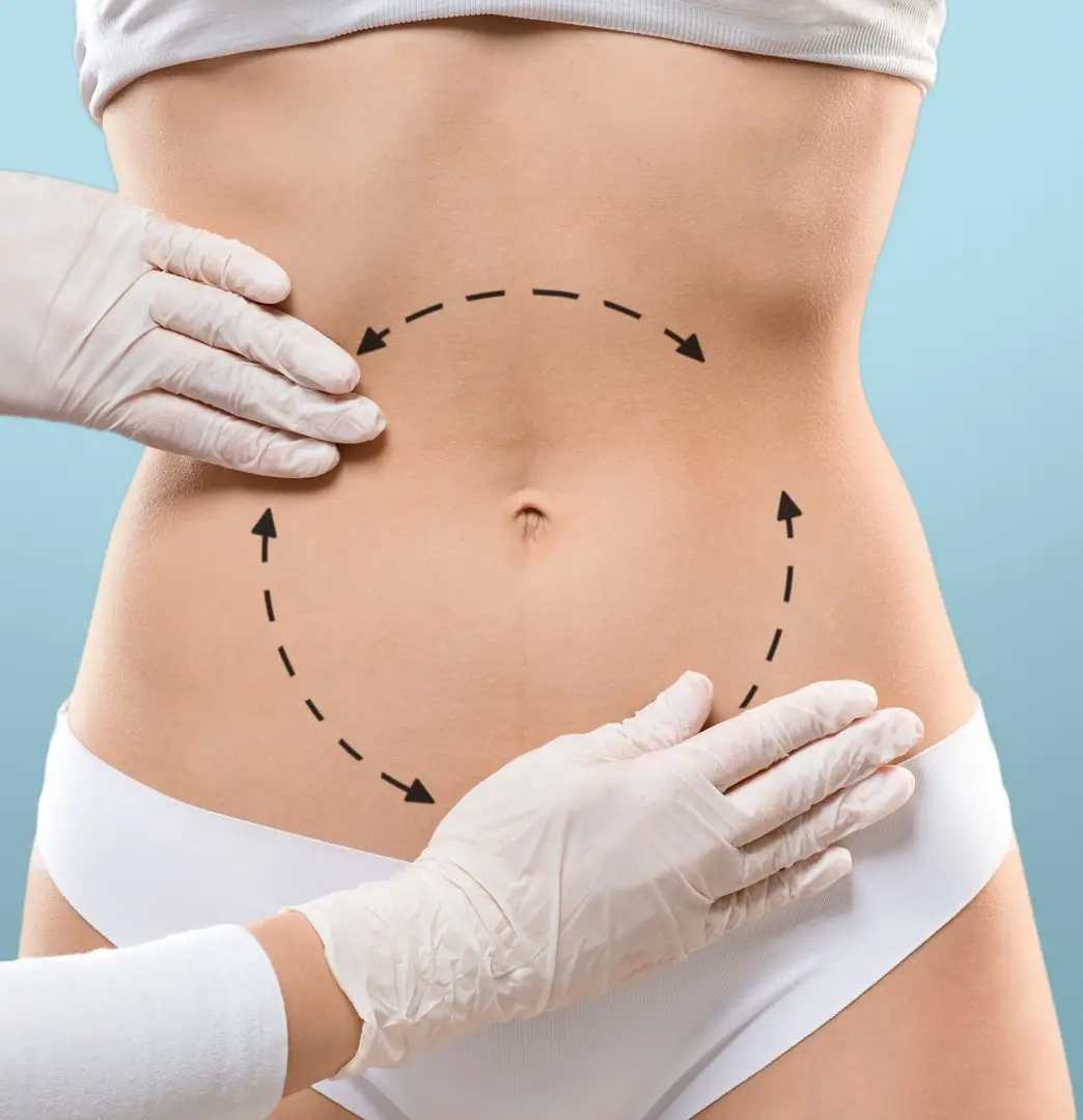 Tummy Tuck / Abdominoplasty